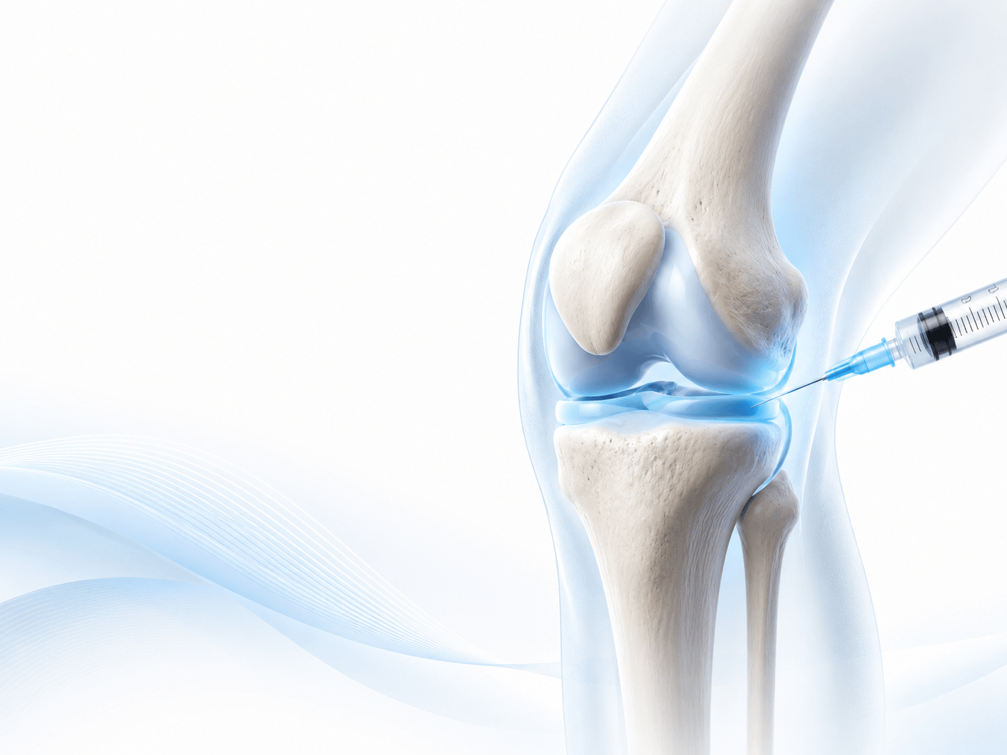 Medical illustration of a knee joint injection